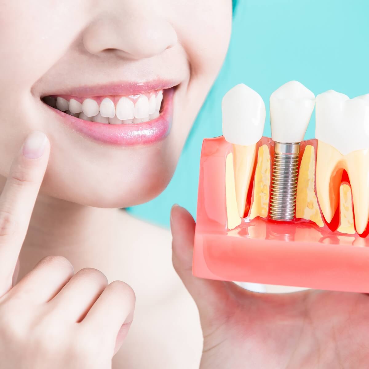 Dental Implants Special