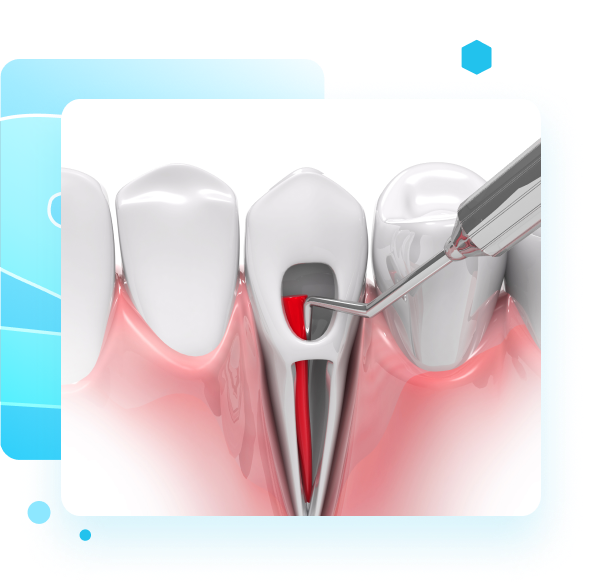 Root Canals