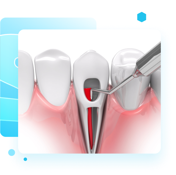 Root Canals