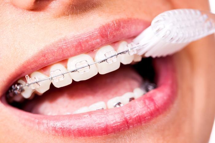 teeth cleaning with braces