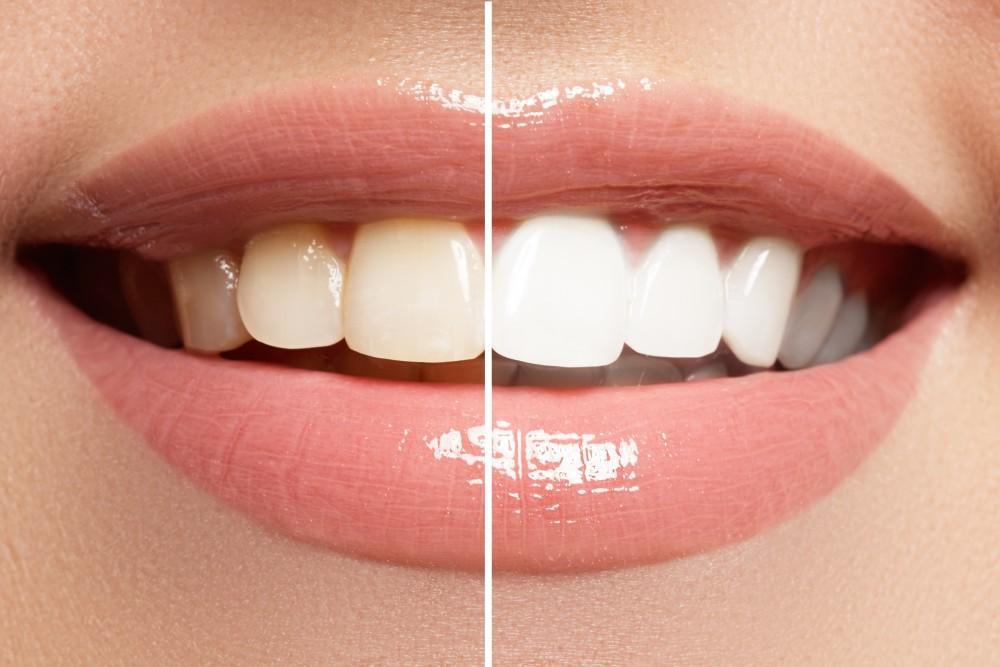 Which Type of Teeth Whitening Should I Choose?