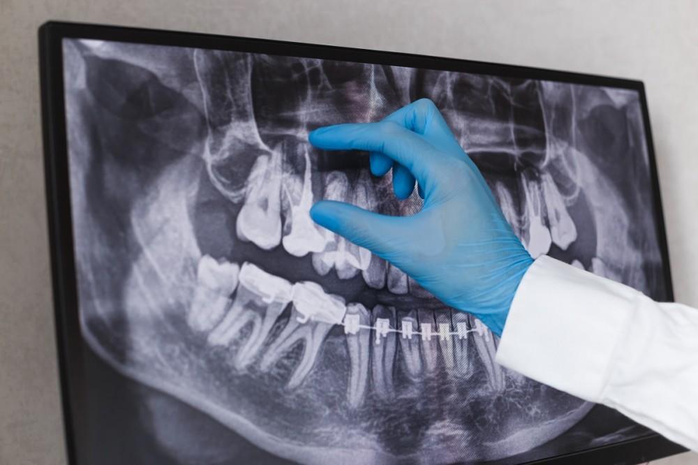 The Importance of Regular Dental X-rays