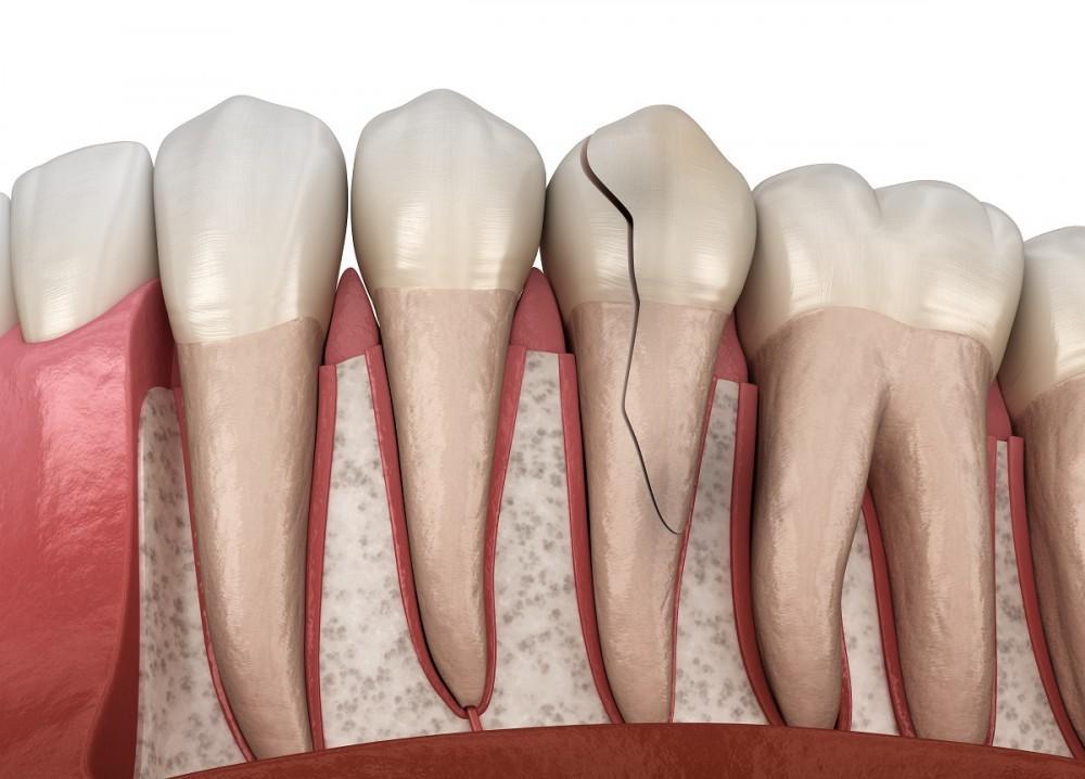 Have a Cracked Tooth? Here’s What You Need to Know