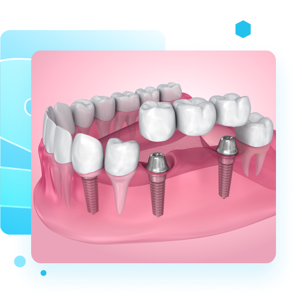 Multi-Tooth Implants
