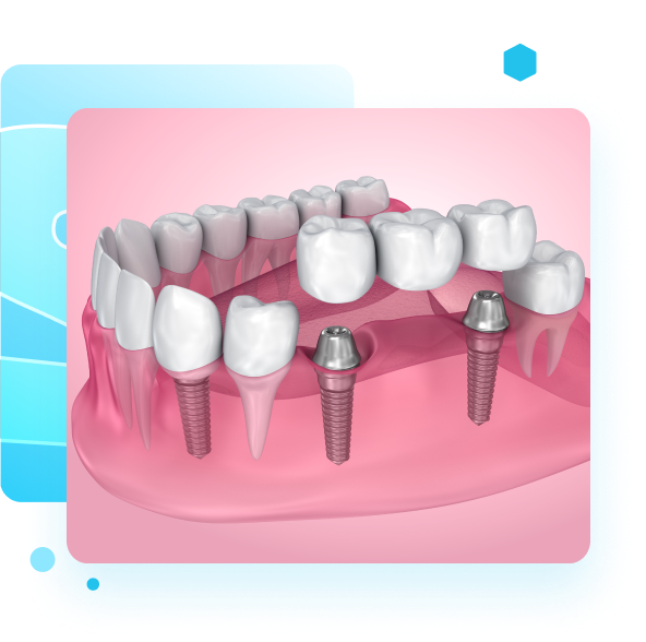 Multi-Tooth Implants