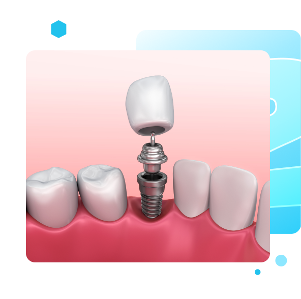 Single Tooth Implants